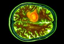 Краплі в ніс показують багатообіцяючі результати в боротьбі зі смертельним раком мозку