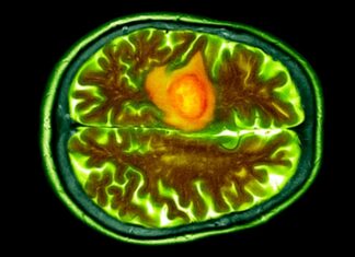 Le gocce nasali sono promettenti nella lotta contro il cancro al cervello mortale