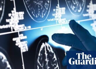 Nowa recenzja poddaje w wątpliwość rzeczywistą skuteczność leków na Alzheimera